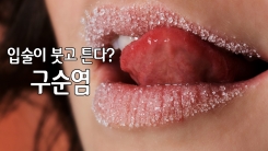 환절기, 입술이 트고 갈라진다?