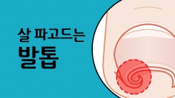 겨울철 부츠 '내향성 발톱' 유발