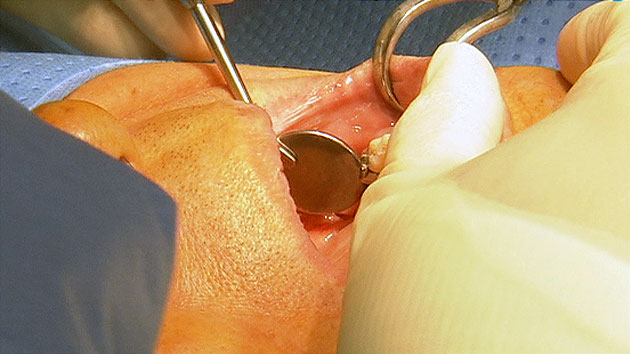 치과 분쟁, 임플란트가 가장 많아