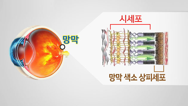 배아줄기세포로 실명 환자 시력 회복