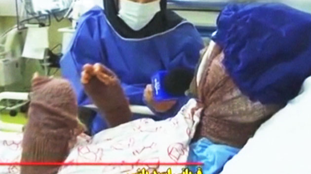 이란 여성에 잇단 '산성물질 테러'...후폭풍