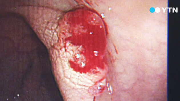 60대 남성 10명중 1명 '대장암 전단계'