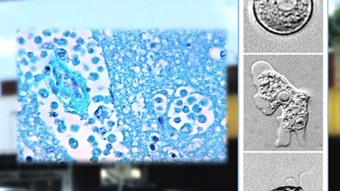 美 '뇌 먹는 아메바' 감염 또 확인...치사율 95%
