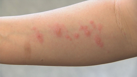 대상포진 환자 4년새 34%↑...노인들 면역력 약해지면 발병