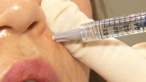 성형 '필러' 부작용 증가..."입가·코 시술 특히 주의"