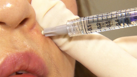 성형 '필러' 부작용 증가..."입가·코 시술 특히 주의"