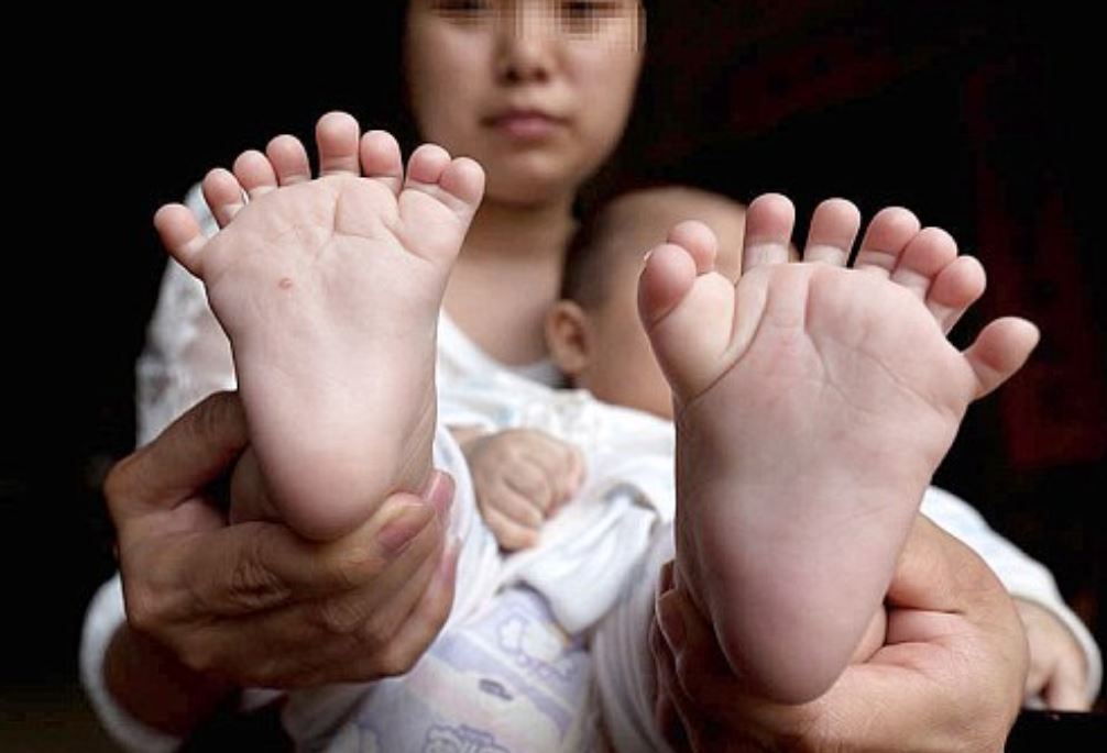 손가락 15개·발가락 16개 갖고 태어난 아기