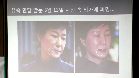  박 대통령 얼굴 주사바늘 자국 의혹 제기에 "필러 자국 같다"