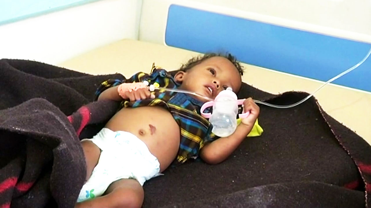 예멘 콜레라 전염 36만8천 명...사상 최악 우려