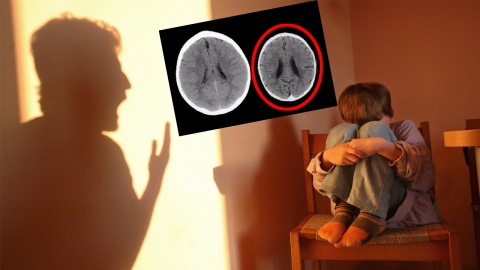 학대받은 아이와 사랑 받은 아이, 뇌 구조에 큰 차이