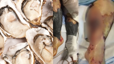 50대 여성, 생굴 먹고 '패혈증' 걸려 사망