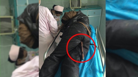 엉덩이에 철근 관통한 인부, 극적으로 목숨 건져