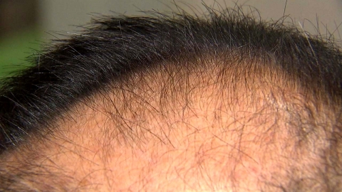 수면 무호흡 환자, 탈모 가능성 최대 7배