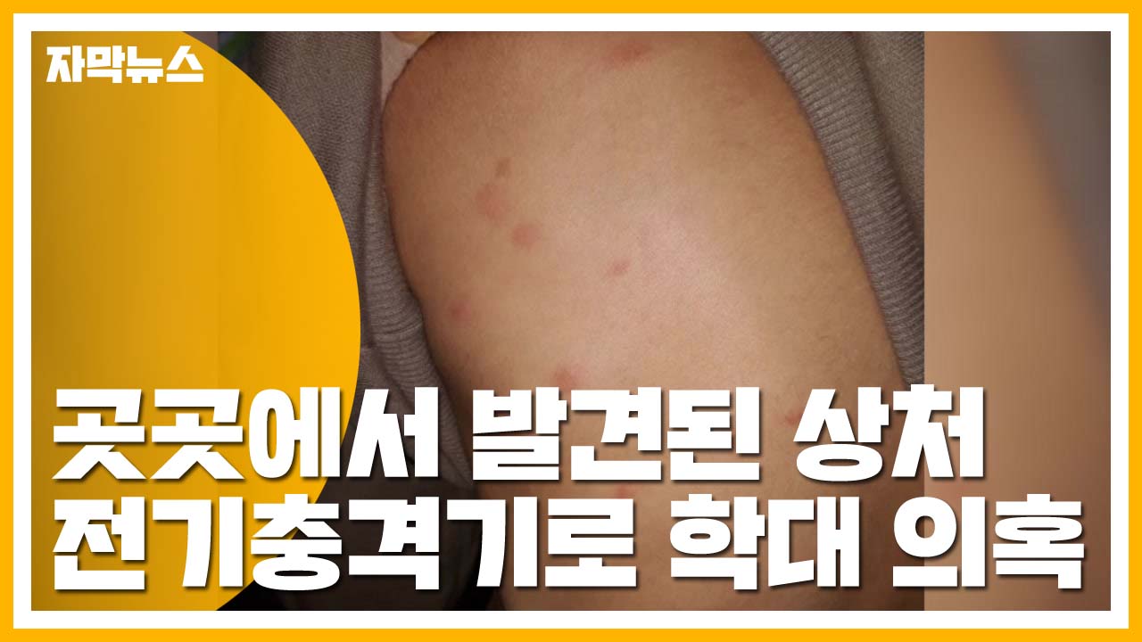 [자막뉴스] '선명한 상처들'...전기충격기로 장애 아동 학대한 원장