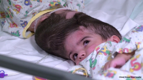 머리 붙은 샴쌍둥이 자매, 英서 50시간 수술 끝에 분리 성공