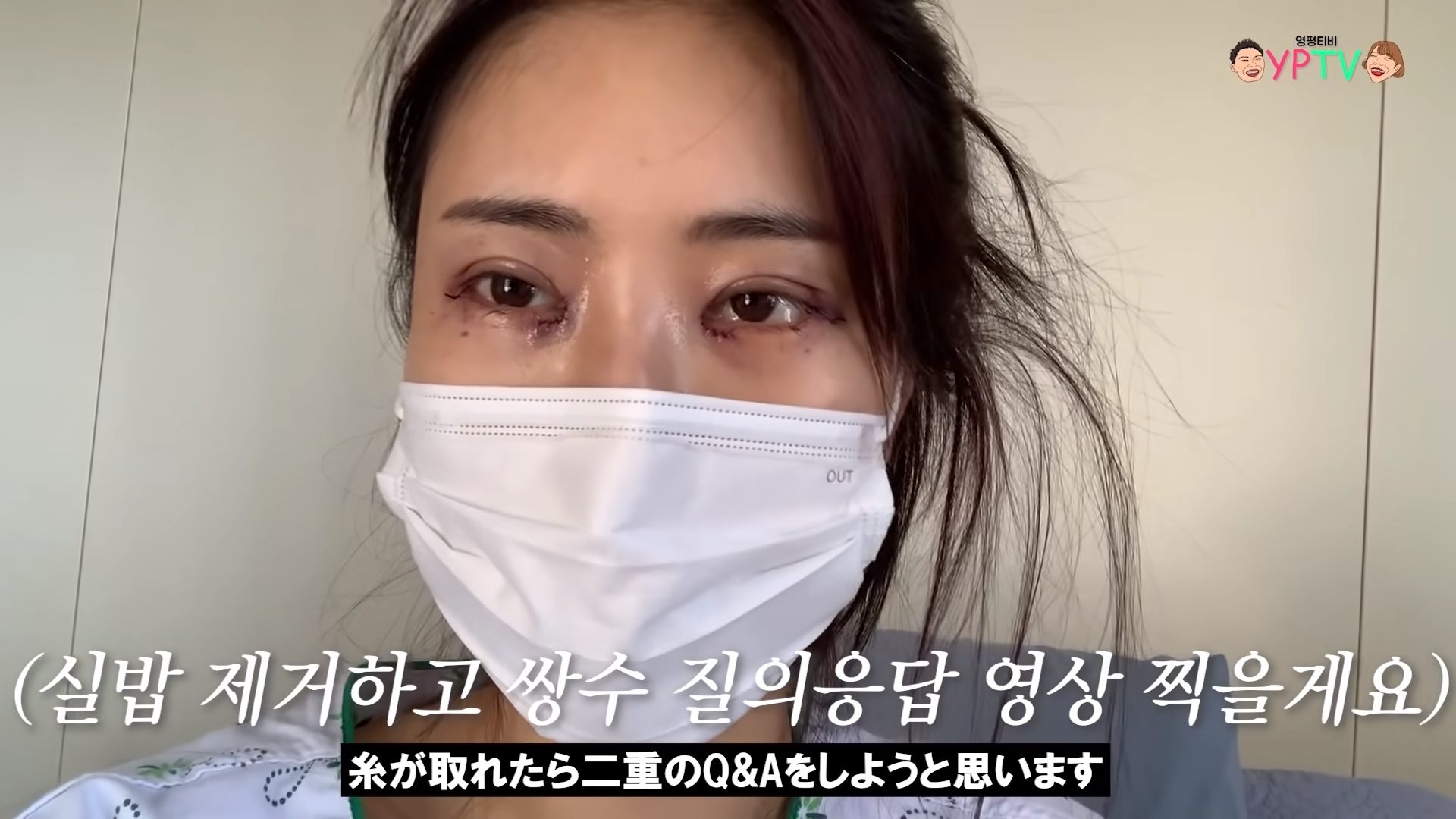 “잘 된 것 같나요?” 이세영, 쌍꺼풀 수술 전후 모습 공개… 조회수 25만 관심