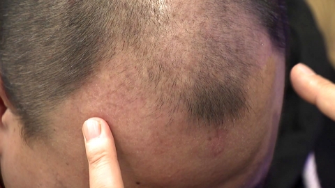 “초간단 탈모 확인! 뒤통수를 만지면 안다!” 