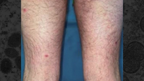 미 캘리포니아주, 원숭이두창 비상사태 선포