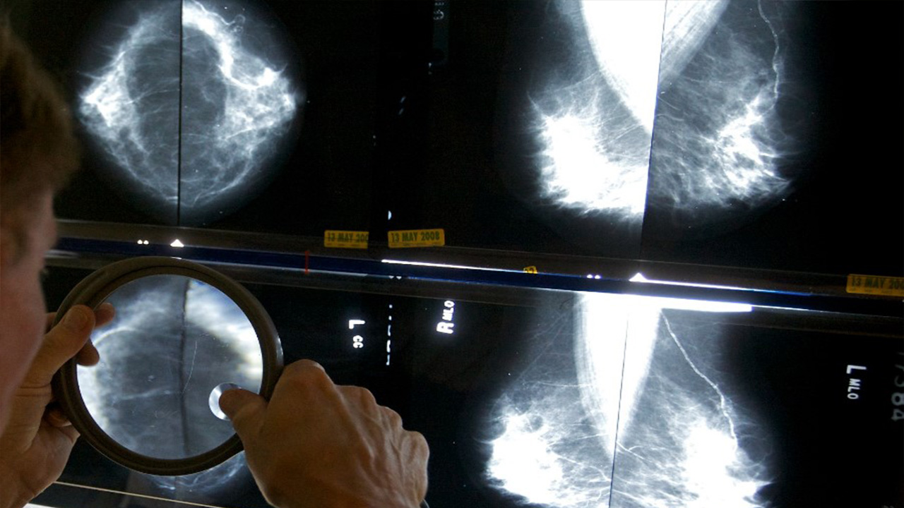 '의사가 발견 못한 유방암' AI가 다수 찾아내...헝가리서 대규모 시험 중