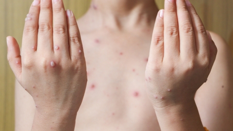 부산서 5년 만에 홍역 환자 1명 발생...확산 방지 총력