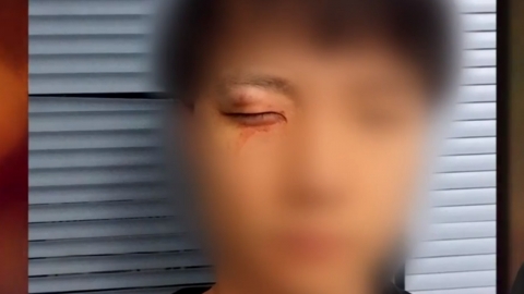 "눈 작다며 욕설"...20대 한국인, 호주 백인들에 집단폭행 당해