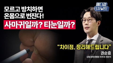 [Medical Insight 53rd] Symptoms and treatment of "T-eye and Warts" by dermatologists.