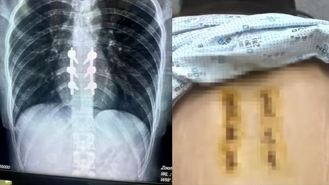 Boyfriend who bet on "throwing girlfriend"...Fractured the spine, separated from the dive.