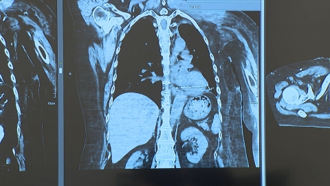 Rare cancer that's indistinguishable from normal cancer...find one's way through a sequencing test