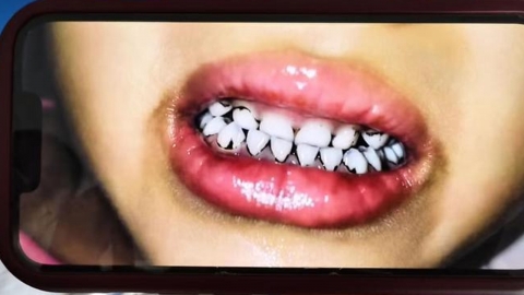 중국 유치원생 70명 집단 납중독...머리 빠지고 치아 까매져