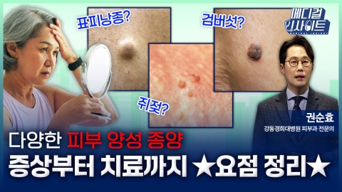 [메디컬 인사이트 105회] 피부과 전문의가 알려주는 '피부양성종양의 치료법'