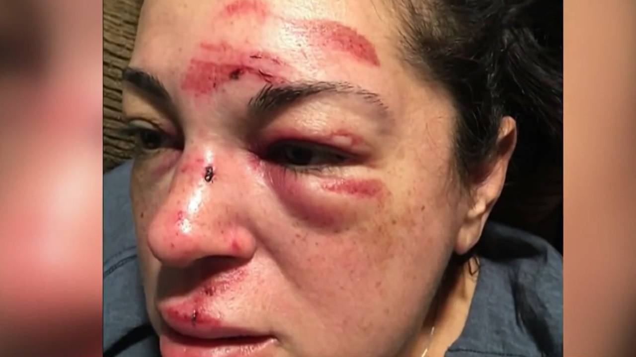 보도블록 걸려 넘어져 뇌 손상된 美 여성, 106억원 합의금