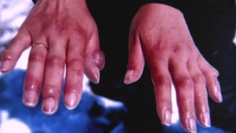 겨울 추위 시작…"저체온증·동상 등 한랭질환 주의"