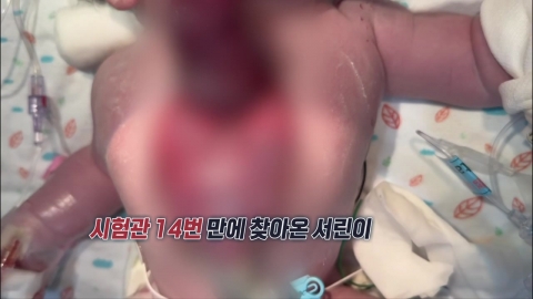 몸 바깥에서 심장 뛰던 \'서린이\', 국내 첫 수술 성공…"절망 속 희망 준 의료진께 감사" [앵커리포트]