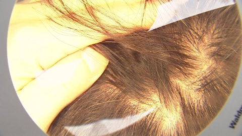 "탈모는 생존 문제"라지만…재정 부담·우선 순위 \'난관\'