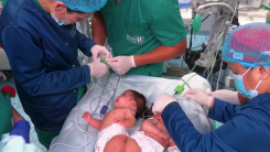 페루 '척추 붙은 샴쌍둥이 분리' 고난도 수술 성공..."놀라운 ...