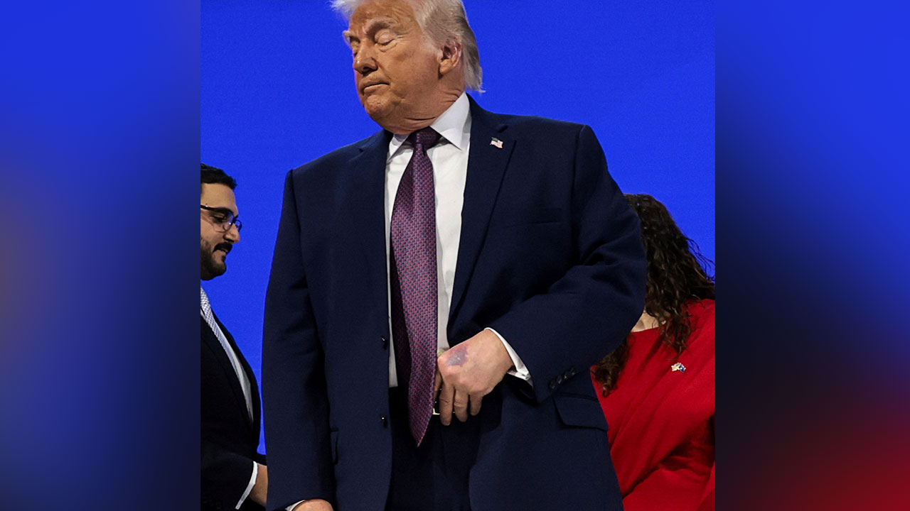 트럼프 손에 또 멍자국...이번엔 "테이블 부딪혔다"