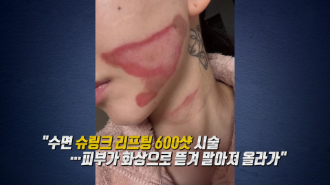 AOA 권민아, 리프팅 시술 받다 ’심재성 2도 화상’…"공황 발작 왔다" [앵커리포트]