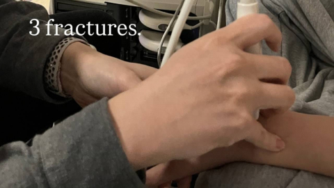 뼈 부러진 채 금메달 땄나…최가온, SNS에 "3곳 골절"