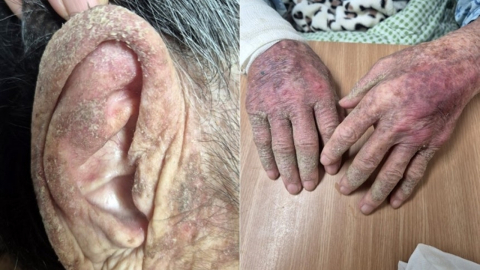 90대 노인, 옴 악화에 \'코끼리 피부\' 됐는데…"요양센터가 치료 방임"