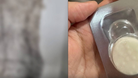 산부인과 시술 후 몸에서 거즈 나왔는데…의료진 '무혐의'