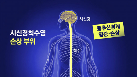 "만신창이 돼야 3차 치료제"…시신경척수염 환자의 그늘