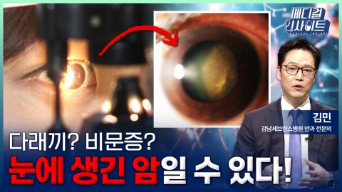 [메디컬 인사이트 137회] 안종양의 증상과 치료법